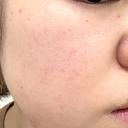 ピーリング（ハリ・ツヤ） / ルメッカ PureMe Skin Clinic（ピュアミースキンクリニック麻布） BEFORE サムネイル用