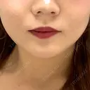 ボトックス（エラ・小顔） 形成外科と美容外科のクリニック池袋 BEFORE サムネイル用