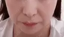 肌ヒアルロン酸注入（たるみ・シワ改善） DMTC美容皮膚科 大宮院 BEFORE サムネイル用