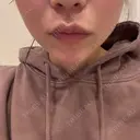 ヒアルロン酸注入（涙袋） / 脂肪溶解注射（顔） 麻布十番クレールデンタルクリニック BEFORE サムネイル用