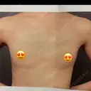 豊胸（シリコン＋脂肪併用） BUST CLINIC（バストクリニック） 東京 BEFORE サムネイル用