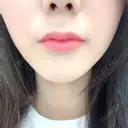 ヒアルロン酸注入（唇） / ボトックス（口角） フィラークリニック 恵比寿院 BEFORE サムネイル用