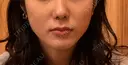 ボトックス（エラ・小顔） TCB東京中央美容外科 池袋西口院 BEFORE サムネイル用