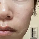 ピーリング（ニキビ・毛穴） / 光治療（フォトフェイシャルなど） RAISE CLINIC 【レイズクリニック】 BEFORE サムネイル用