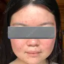 美肌レーザー / 赤み除去レーザー / ニキビ治療 医療法人河田外科形成外科 BEFORE サムネイル用