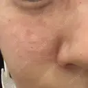 肌育注射（ジュベルックなど） 城本クリニック 長野院 BEFORE サムネイル用