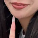 ボトックス（あご） / ヒアルロン酸注入（あご） / ボトックス（口角） / シワ取りボトックス / ボトックス（人中） / ヒアルロン酸注入（鼻翼基部） 目白ホワイトクリニック BEFORE サムネイル用