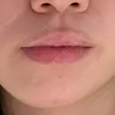 ヒアルロン酸注入（あご） / ヒアルロン酸注入（唇） / ボトックス（口角） ルラ美容クリニック 大阪本院 BEFORE サムネイル用