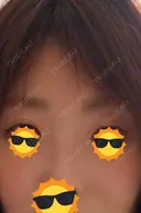 二重埋没 / 眉下切開 ネビュラクリニック 京都院 BEFORE サムネイル用