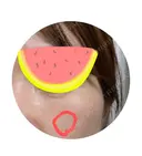 その他（肌） スマートスキンクリニック 神保町院 BEFORE サムネイル用