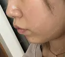 ヒアルロン酸注入（あご） / ヒアルロン酸注入（鼻翼基部） / RF（高周波）たるみ治療 gift clinic BEFORE サムネイル用