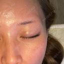ダーマペン LIFIX BEAUTY CLINIC BEFORE サムネイル用