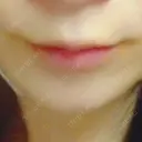 ボトックス（エラ・小顔） / 脂肪溶解注射（顔） / ヒアルロン酸注入（唇） / ボトックス（口角） the way（ザウェイ）整形外科 BEFORE サムネイル用