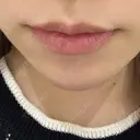 ヒアルロン酸注入（唇） AZ BEAUTY CLINIC BEFORE サムネイル用
