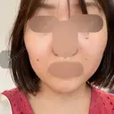 RF（高周波）たるみ治療 ルラ美容クリニック 福岡本院 BEFORE サムネイル用