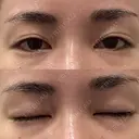 二重埋没 城本クリニック 福岡院 BEFORE サムネイル用