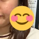 肌育注射（ジュベルックなど） シェリークリニック 福岡院 BEFORE サムネイル用