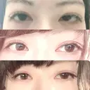 眼瞼下垂（切開） 札幌中央形成外科 BEFORE サムネイル用