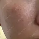 フォトRF 共立美容外科 仙台院 BEFORE サムネイル用