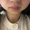 毛穴洗浄（ハイドラフェイシャルなど） / ポテンツァ ゆう美容クリニック BEFORE サムネイル用