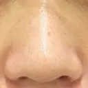 鼻尖形成（切開） / 小鼻縮小（切開） / 軟骨移植 ブルームクリニック（BLOOM CLINIC） BEFORE サムネイル用