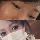 二重埋没 城本クリニック 姫路院 BEFORE サムネイル用