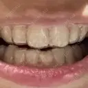 ホワイトニング 緑のテラス歯科クリニック BEFORE サムネイル用