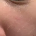 リジュラン 小木曽クリニック BEFORE サムネイル用