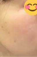 ルビーレーザー AZ BEAUTY CLINIC BEFORE サムネイル用