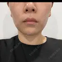 脂肪溶解注射（顔） / プラズマ治療 LE CLINIC BEFORE サムネイル用