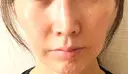 肌育注射（ジュベルックなど） / その他（肌） ゆきスキンクリニック 東池袋 BEFORE サムネイル用