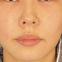 鼻尖形成（切開） / 鼻中隔延長（切開） / 軟骨移植 / 鼻孔縁下降 LIVIN CLINIC BEFORE サムネイル用