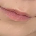 ヒアルロン酸注入（涙袋） / ヒアルロン酸注入（唇） PRO CLINIC プロクリニック 銀座院 BEFORE サムネイル用