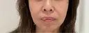ショッピングリフト Natural Skin Clinic 笹塚院 BEFORE サムネイル用