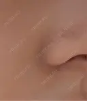 毛穴洗浄（ハイドラフェイシャルなど） クララビューティクリニック 札幌院 BEFORE サムネイル用