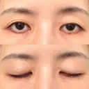眼瞼下垂（切開） WOM CLINIC GINZA （ワム クリニック ギンザ） BEFORE サムネイル用