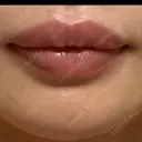ヒアルロン酸注入（唇） アネシス美容クリニック BEFORE サムネイル用