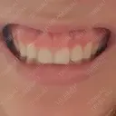 ガミースマイル手術 / その他（口元） 美容皮膚科ピュアビューティー恵比寿 BEFORE サムネイル用