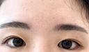二重埋没 OMI CLINIC 【オミクリニック】 BEFORE サムネイル用