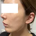 光治療（フォトフェイシャルなど） RAISE CLINIC 【レイズクリニック】 BEFORE サムネイル用