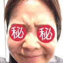 シワ取りボトックス / ボトックス（眉間） / ボトックス（額） / その他（肌） 湘南美容クリニック 大阪四ツ橋院 BEFORE サムネイル用
