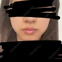 ボトックス（エラ・小顔） TCB東京中央美容外科 天王寺院 BEFORE サムネイル用