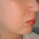 RF（高周波）たるみ治療 PureMe Skin Clinic（ピュアミースキンクリニック麻布） BEFORE サムネイル用