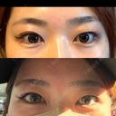 二重切開 LUHO（ルホ）美容外科 BEFORE サムネイル用