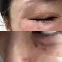 肌育注射（ジュベルックなど） BAO CLINIC 梅田院 BEFORE サムネイル用