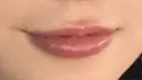 ヒアルロン酸注入（唇） Wing clinic 豊中駅前院 BEFORE サムネイル用