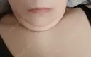 糸リフト / 脂肪吸引注射（顔） EMMO FACE CLINIC 大阪梅田院 BEFORE サムネイル用