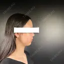 二重埋没 / 目頭切開 / 鼻尖形成（切開） / その他（鼻） / クマ治療 / 脂肪吸引（顔） / 軟骨移植 / 鼻孔縁挙上 R Beauty CLINIC 銀座院 BEFORE サムネイル用
