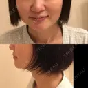 小鼻縮小（切開） / 鼻尖縮小 表参道スキンクリニック 表参道院 BEFORE サムネイル用