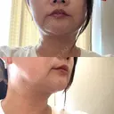 ハイフ（顔） 共立美容外科 広島院 BEFORE サムネイル用